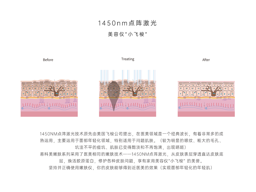 1、1450nm点阵激光.jpg